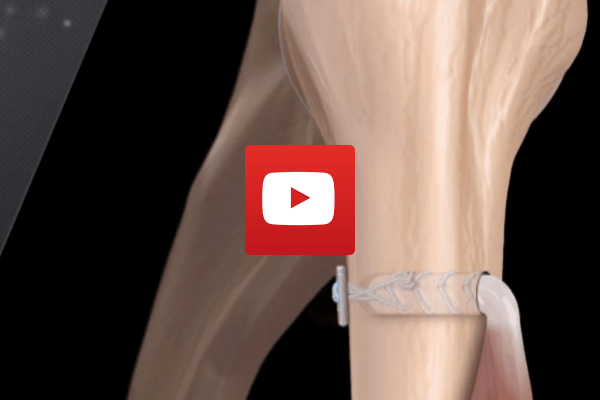 Button Bicep Repair | Dr James McLean | Orthopaedic Surgeon | ASULC | Adelaide