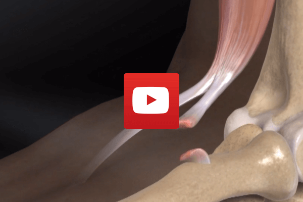 Distal Biceps Repair | Dr James McLean | Orthopaedic Surgeon | ASULC | Adelaide