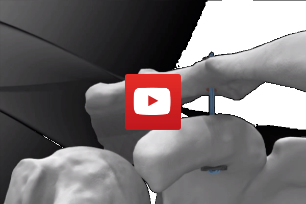 Shoulder AC Tightrope Reconstruction Animation | Dr James McLean | Orthopaedic Surgeon | ASULC | Adelaide